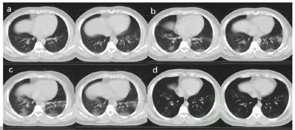 Wow. 
The paper on healing a COVID-19 patient with Traditional Chinese Medicine that I critiqued on PubPeer appears to have copied CT scan images from another paper by another group. 
See: 
pubpeer.com/publications/5…
and
scienceintegritydigest.com/2020/03/09/som…