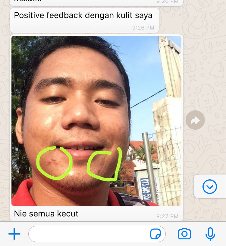 hudaaaleee's tweet photo. Nampak dak difference after tried zarzou serum? After 3 days effect 🥺
-
Mana tak happy ishh peloles lah dia pasniii ❤️❤️❤️ 
-
Thanks for sharing feedback. Positive result pulak tu hiks. Slowly but surely okay. 
-
For those yg nak try solve kan skin problems, come dm me now ✌🏼 https://t.co/Ou9Gvl9NRS