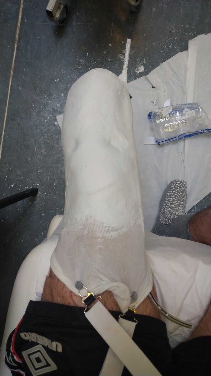 VincentKStoker's tweet photo. Just had my cast and fitting done for my prosthesis. Exciting times ahead 🎉#amputee #amputeelife #belowkneeamputation https://t.co/bk2m1Btsz8