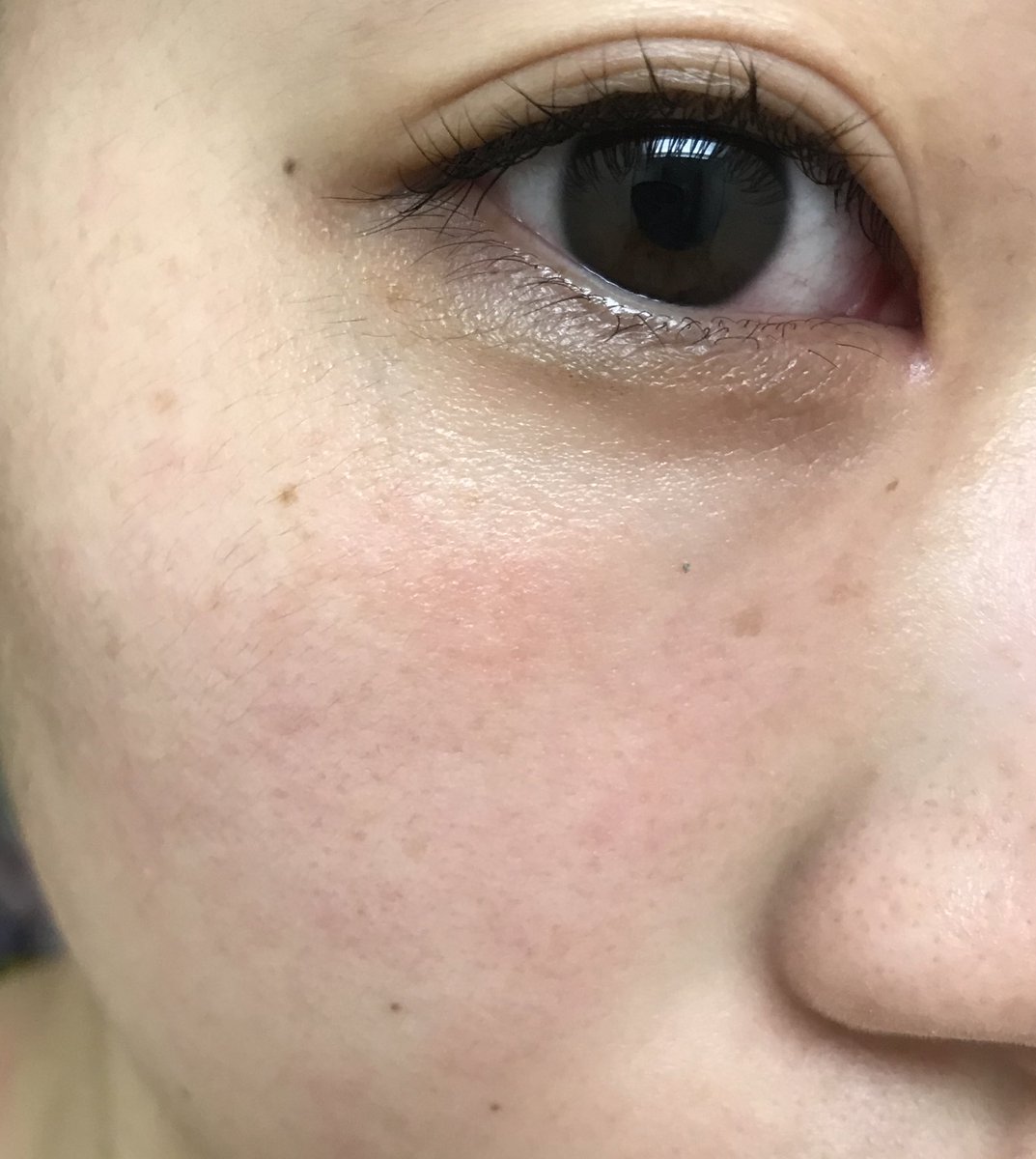 まい 酒さ様皮膚炎 記録用 風呂上がり 今日は肌がぴりつく 肌に化粧をするのが月1くらいになって3ヶ月ほど経過 酒さ様 皮膚炎 肌荒れ