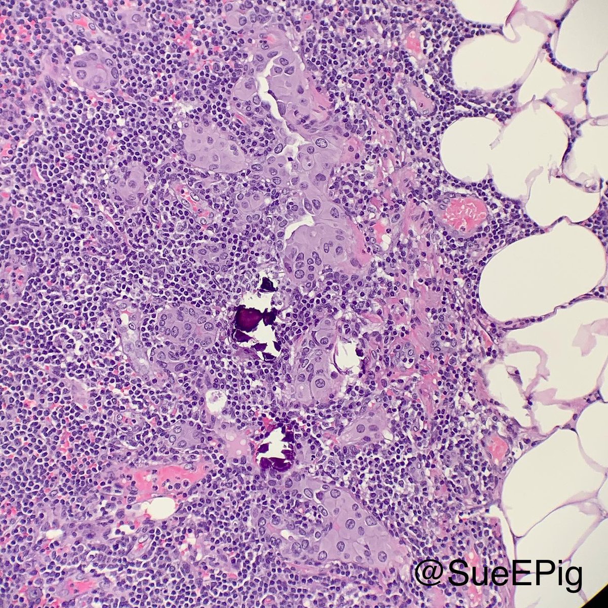 #expecttheunexpected lymph node dissection for #squamouscellcarcinoma of tongue #smallestfocusEVER #papillarythyroidcarcinoma #HNpath