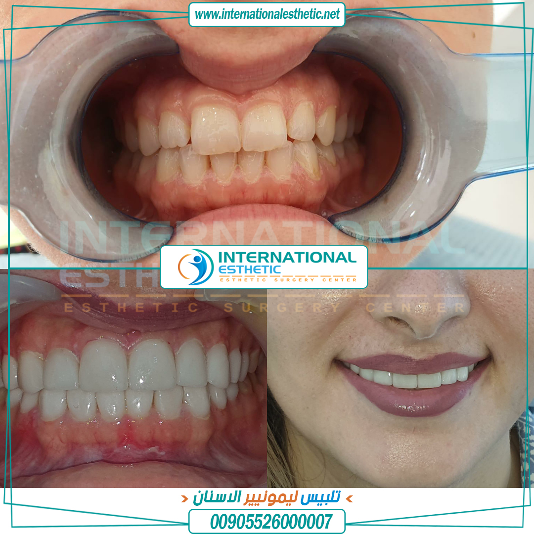 inte_esthetic's tweet photo. مشفى انترناشونال استاتيك / صورة #تجميل_الأسنان

https://t.co/VE7R3EIIuw

--
كافة عمليات التجميل و زراعة الشعر و #تكميم المعدة و #شفط_الدهون والعلاجي الطبي في تركيا.
 
-------
للاستعلام:
00905526000007
وكيلنا في #الكويت : 67705777/97133322

#تبيض_الاسنان
#تجميل_الوجه
#زراعة_اسنان https://t.co/opb1AN7AMr
