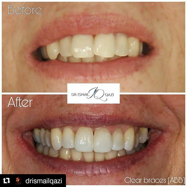 Look at that smile! Amazing results 👏🥳 #Repost @drismailqazi
・・・
4 months clear aligners minor composite bonding and whitening. The difference in confidence is clear from the type of smile they gave when they were told to 'smile' in the before an… ift.tt/2WcnN4L