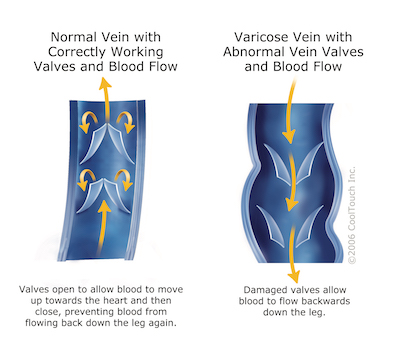 ArtemisColorado's tweet photo. New Blog Posted: What Causes Varicose Veins? https://t.co/OjeeAdGNkJ https://t.co/XFTWlj9GYU