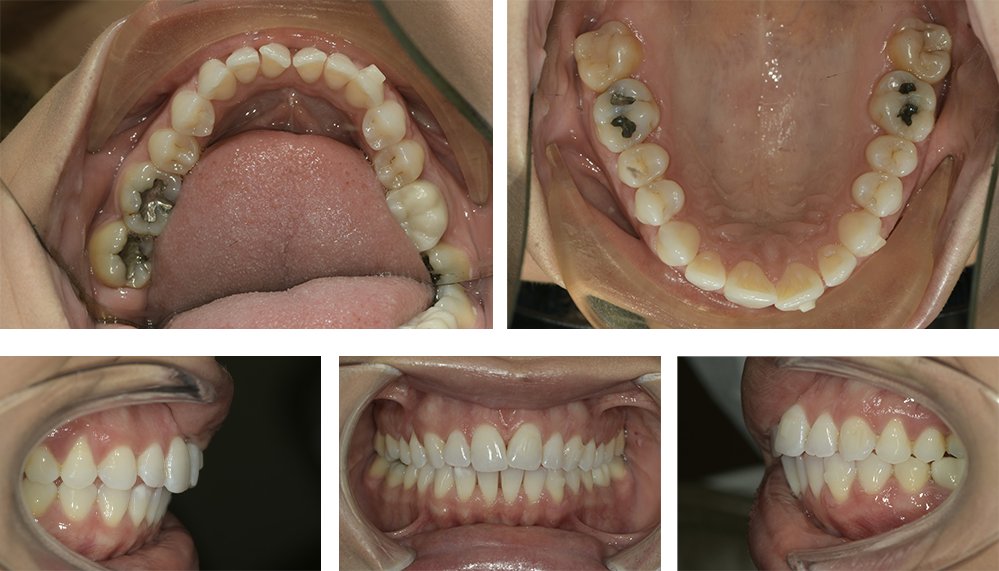 suresmile's tweet photo. New #TheSmileProject update on our blog!
Alexa has been back to see Dr. Brian Wilk and her treatment is progressing as planned! https://t.co/h9yP1JOtSY…/

The first set of photos (left): September 5, 2019
The second set of photos (right): December 5, 2019
#SureSmile https://t.co/xaCE1QwUqJ