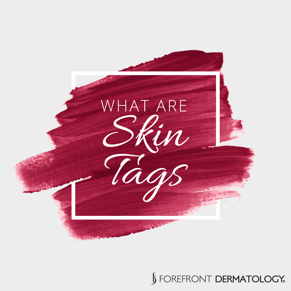 FDTysonsCorner's tweet photo. A #SkinTag is a small, soft, benign skin growths commonly found on the neck, armpits and groin area. The exact causes of skin tags are unknown, pregnancy, family history and friction are shown to increase your chances of developing them. https://t.co/2eMkaQ4JUO