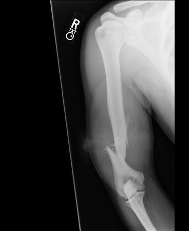 Orthopaedics MSc UCL (@orthomscucl) on Twitter photo Spiral fracture of the distal one-third of the humeral shaft is known as the Holstein-Lewis fracture, commonly associated with radial nerve injury (22% incidence) 
#orthotwitter #MScUCL Spiral fracture of the distal one-third of the humeral shaft is known as the Holstein-Lewis fracture, commonly associated with radial nerve injury (22% incidence) 
#orthotwitter #MScUCL