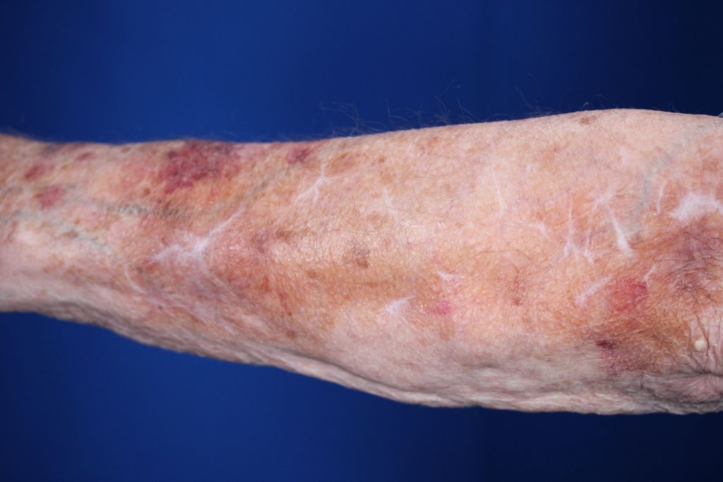 contourderm's tweet photo. ➡️ This patient has thinning skin which is skin that tears, bruises, or breaks easily. Thin skin is sometimes called thinning skin, or fragile skin. When thin skin develops an appearance like tissue paper, it’s called crepey skin.
#contourderm #Jochenmd #thinningskin https://t.co/AzP7uysLt3