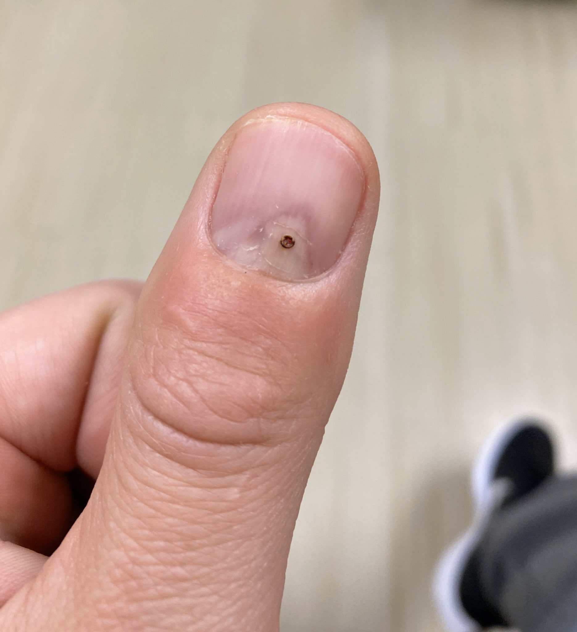 Find a tick lodged in your skin? Here is what you should do | Daily Sabah