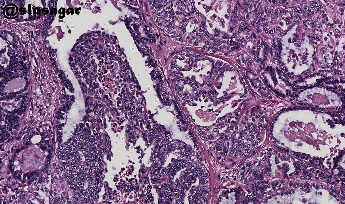 #GYNpath 🧩 time!

adult F, TAH specimen, full-thickness section of endo-myometrium

🤔 🔬❓