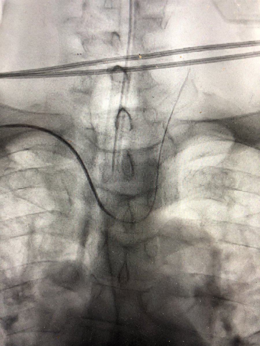 EinsteinIR's tweet photo. No quarantine for #LVO. 62 male 1.5 hour symptoms. Bovine arch? #thinkradial. M2 #occlusion treated with suction #thrombectomy. Residual M3/4 branch occlusion thrombectomy through #3max by @Paul_BradyIR_MD. @BalaNatarajanIR @lippert_john @dmbiederman @vinitkhannamd https://t.co/Yg8fQ8YxA1