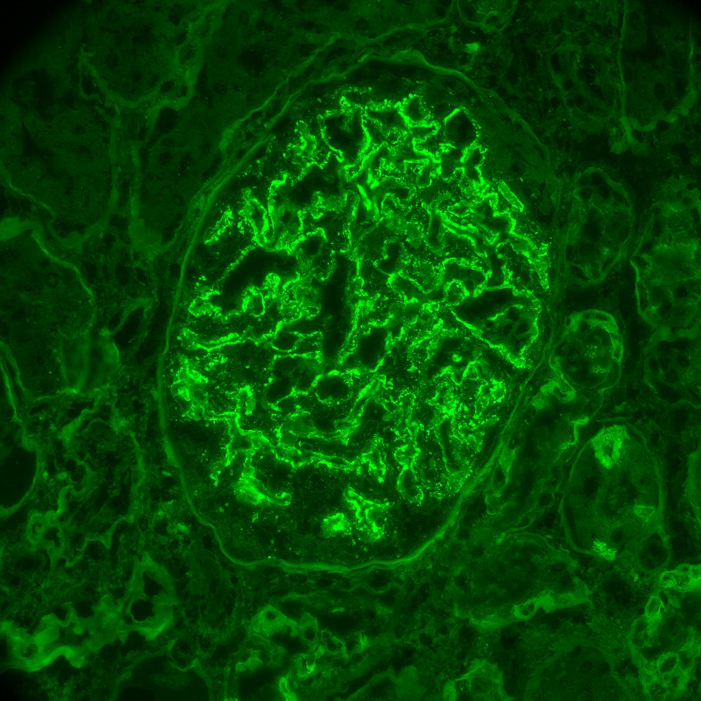 JeanHouMD's tweet photo. Another syphilitic story... Young female w/ untreated syphilis, nephrotic syndrome, severe AKI, and pyuria w/ positive e-coli urine culture.  Dx: Secondary membranous nephropathy and pyelonephritis with bonus positive Treponema IHC.  Syphilis treated and proteinuria disappeared. https://t.co/1yQpIJKDX6