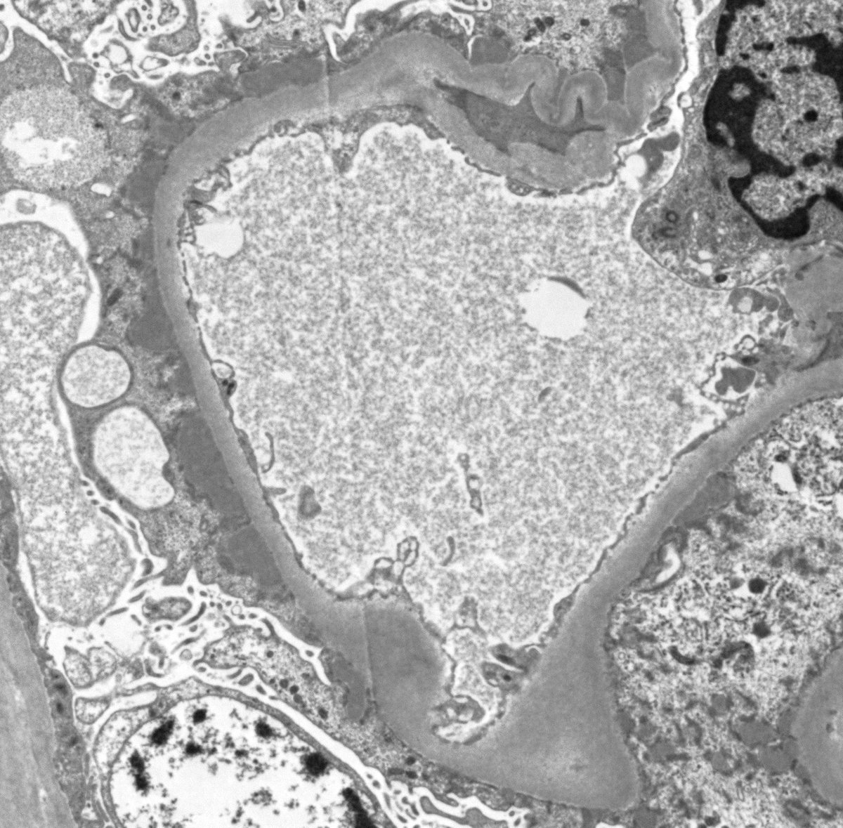JeanHouMD's tweet photo. Another syphilitic story... Young female w/ untreated syphilis, nephrotic syndrome, severe AKI, and pyuria w/ positive e-coli urine culture.  Dx: Secondary membranous nephropathy and pyelonephritis with bonus positive Treponema IHC.  Syphilis treated and proteinuria disappeared. https://t.co/1yQpIJKDX6
