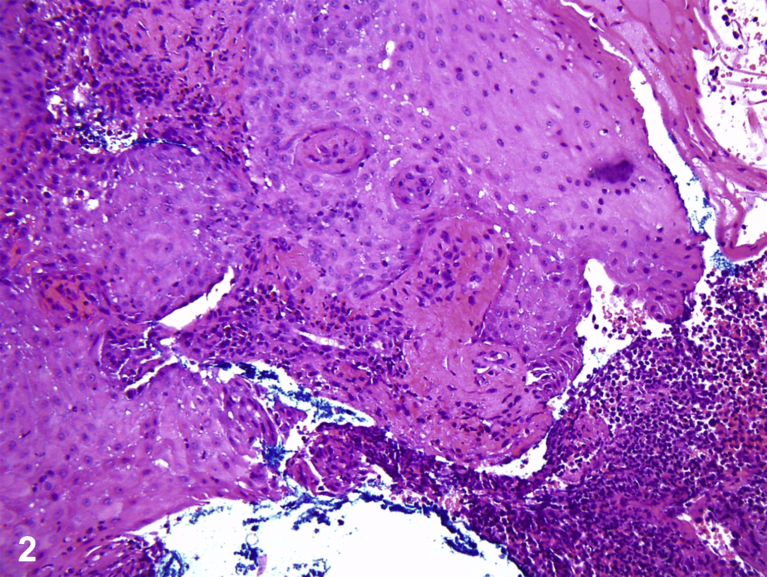 ecthyma gangrenosum histology