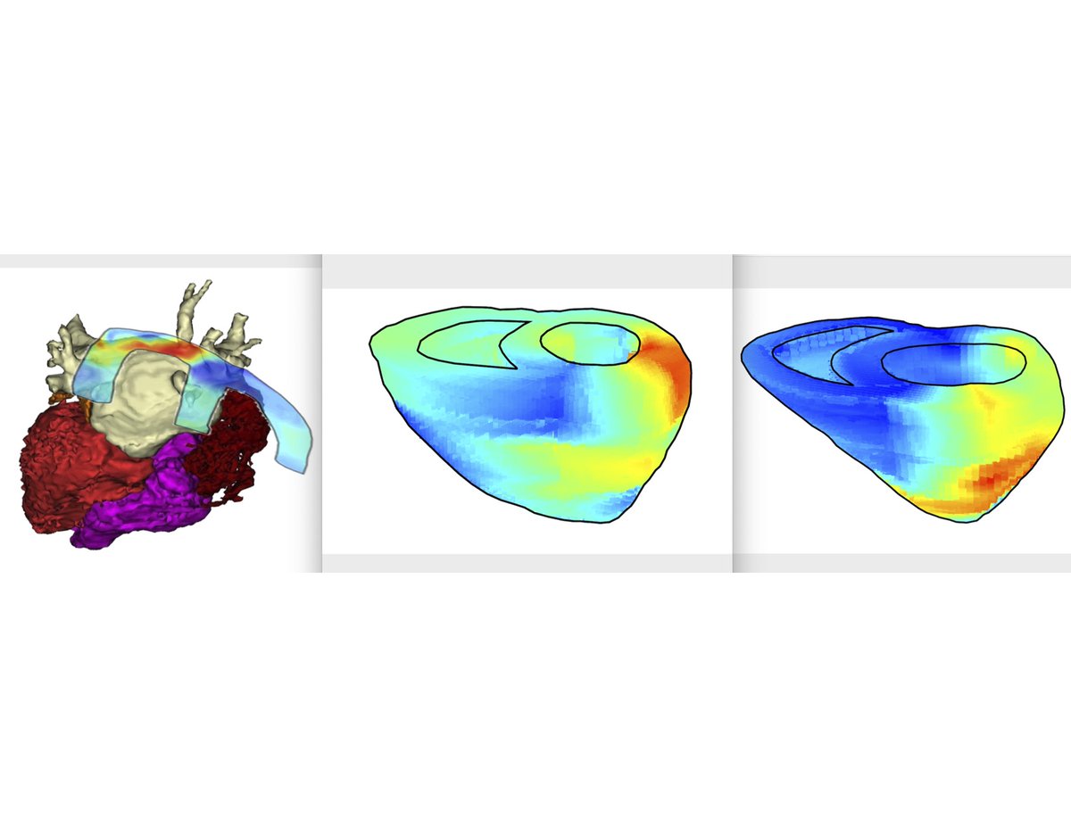Elaine Wan (@elainewanmd) on Twitter photo Congrats to <a href="/LeaMelki9/">Lea Melki</a> & C. Grubb, co-first authors of our paper in <a href="/ScienceTM/">Science Translational Medicine</a> double blinded trial of ultrasound based electromechanical wave imaging on localization of arrhythmias in 55 pts showing accuracy of >96% Great collaboration between <a href="/EPNYP/">rnEPLabNYP</a> and <a href="/ColumbiaUEIL/">Konofagou Lab at Columbia University</a> ! #EPeeps Congrats to <a href="/LeaMelki9/">Lea Melki</a> & C. Grubb, co-first authors of our paper in <a href="/ScienceTM/">Science Translational Medicine</a> double blinded trial of ultrasound based electromechanical wave imaging on localization of arrhythmias in 55 pts showing accuracy of >96% Great collaboration between <a href="/EPNYP/">rnEPLabNYP</a> and <a href="/ColumbiaUEIL/">Konofagou Lab at Columbia University</a> ! #EPeeps