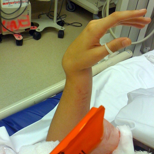 RateMyCastNow's tweet photo. (2/2) Don't fall &amp; break ur wrist... hospitals are cancelling all surgeries.. you'll end up like this for 8 wks

Followers - who've experienced the pain of a broken arm and the misery of a big cast... comment and warn everyone how much it SUCKS! #castprobz https://t.co/JUne3mNcgC