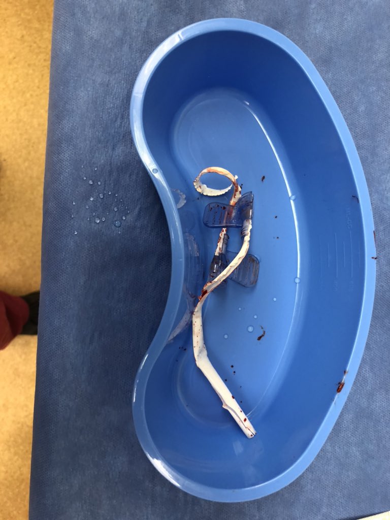 DrAmirOlfat's tweet photo. Just curious to see if anyone else has experience this Arrow SmartSeal? The peelable dialysis sheath broke up and couldn’t be peeled off. This is the second time I saw this. #permacath #arrow #dialysis #IR #vascular #surgery https://t.co/QZBQibmhnz