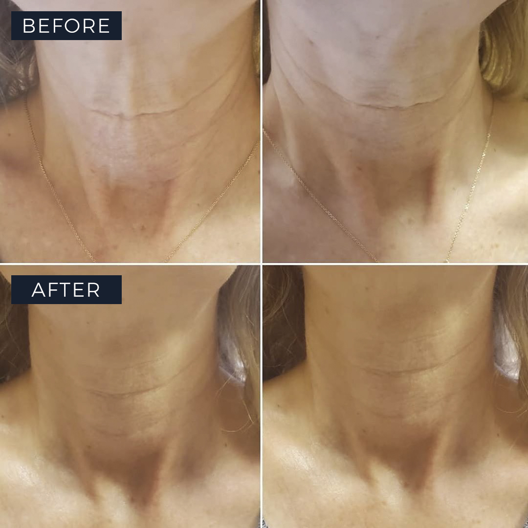 NeauviaUS's tweet photo. Repost @neauvia_in_the_city
 . . .
 Dramatic results from just one treatment! Have you experienced the power of Zaffiro?

Repost from Michael A. Fiorillo, MD.

Immediately after 1 treatment of Zaffiro thermo-lifting.

#NeauviaUS #aesthetics #Zaffiro #skintightening #lifting https://t.co/PcjySHihYz