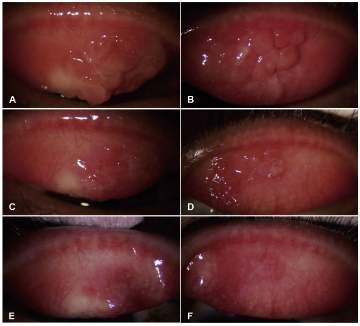 JACIInPractice's tweet photo. In Current Issue! #Amelioration of #conjunctival giant #papillae by #dupilumab in patients with #atopic #keratoconjunctivitis https://t.co/XRmtsgc9KC https://t.co/4hWjJjuHSy