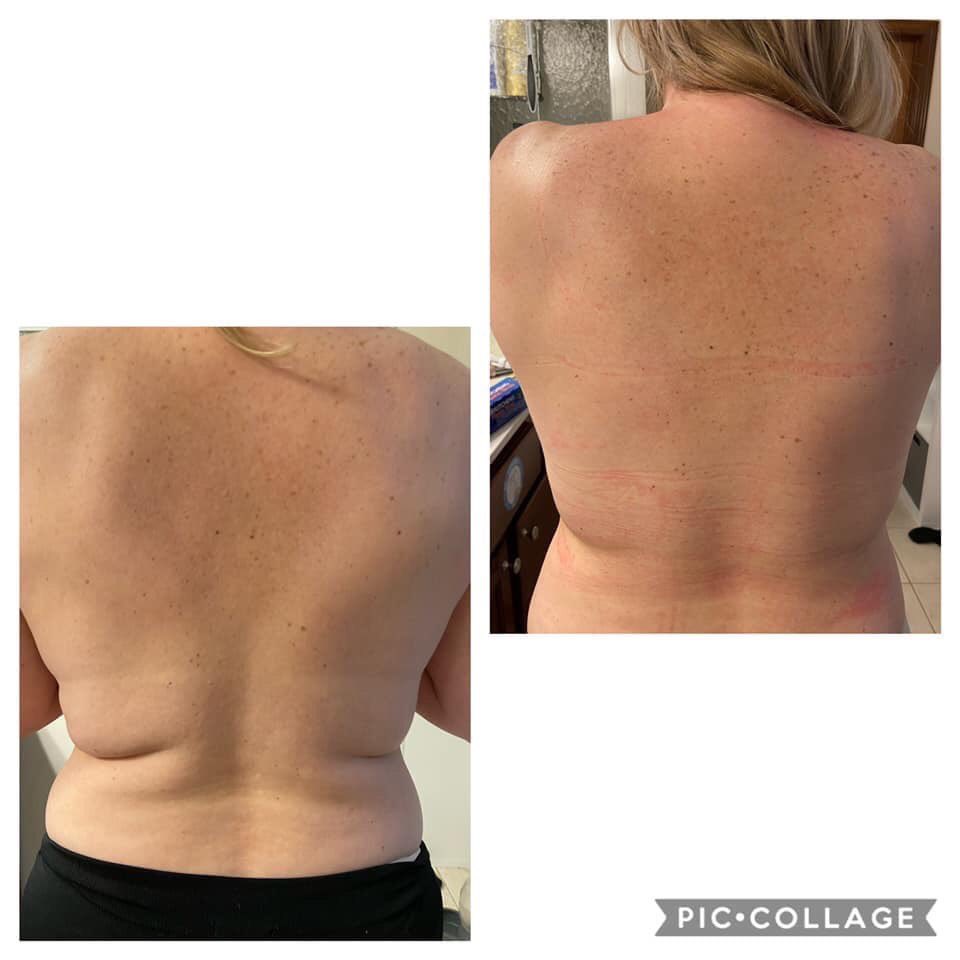 ReyesToomer's tweet image. Some of you want to know if the wraps really work, 🤔well don’t take my word for it, take Shelly’s!!!!￼

“So last night I did round 2 of our Ultimate body wraps on my back!!!
I am so excited about the results.”
#crazywrapthing #itworkswraps