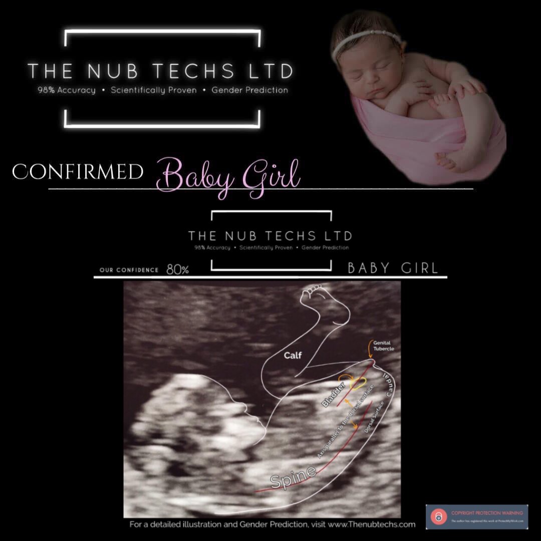 nub_techs's tweet photo. Gender confirmed using Nub Theory to determine baby’s gender from as early as 12 weeks 🤍
https://t.co/fqsptEFhQr
.
.
.
.
.
#12weekspregnant #13weekspregnant #genderreveal #nubtheoryexperts #nubtheoryexplained #nubtheory #babyontheway #baby2020
#firstscan #babyonboard #boyorgirl https://t.co/Ysc3IZURVi