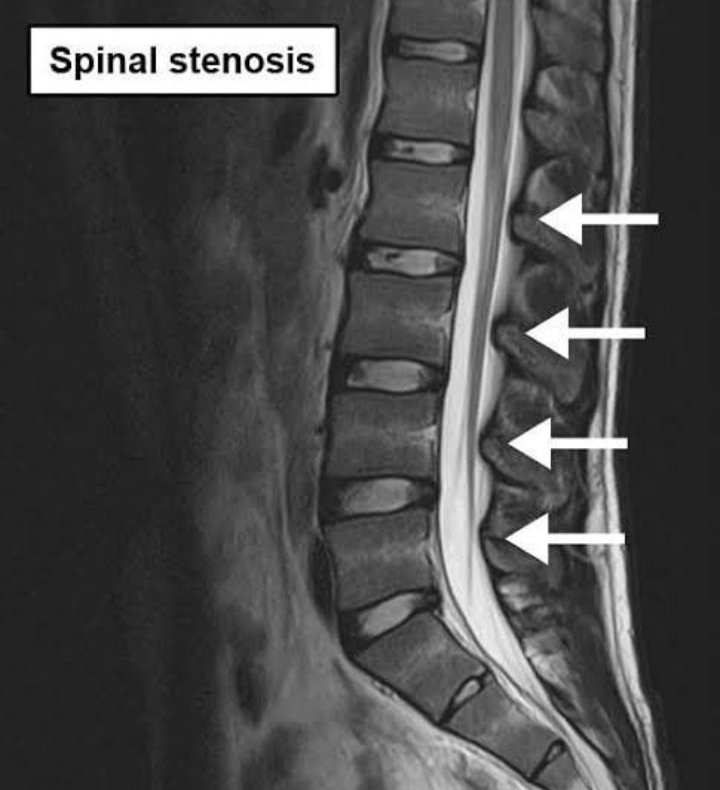 FizyoPlatforum's tweet photo. Halk arasında dar kanal olarak bilinen spinal stenoz,omurganın daraldığı ve omuriliği sıkıştırmaya başladığı bir durumdur.En sık nedeni osteoartrittir.Yazımızın tamamı için🆕️➡️https://t.co/OysCKkquyC
#stenoz #fizikterapi #darkanal #spinalstenosis #anatomy #Neurology #fzt #ftr https://t.co/01pzebiu2w