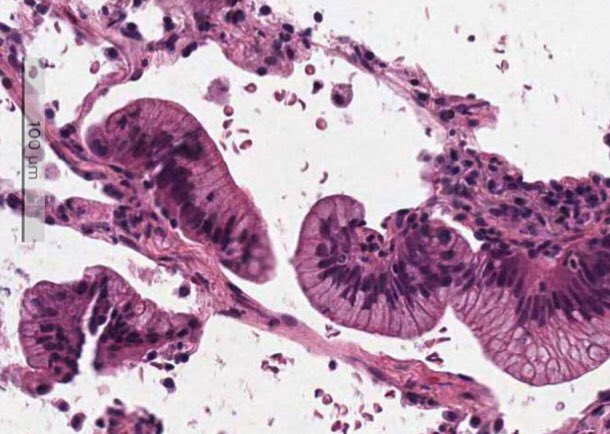 6Patterns's tweet photo. Twitter
#top25 #pearls of #pulmpath No. 6 Don’t order stains on mucinous adenocarcinoma carcinoma. They will just get you into trouble. But a positive CDX2 does favor a malignant process. #6Patterns https://t.co/xvkIiXto9M https://t.co/qlJySwVibt