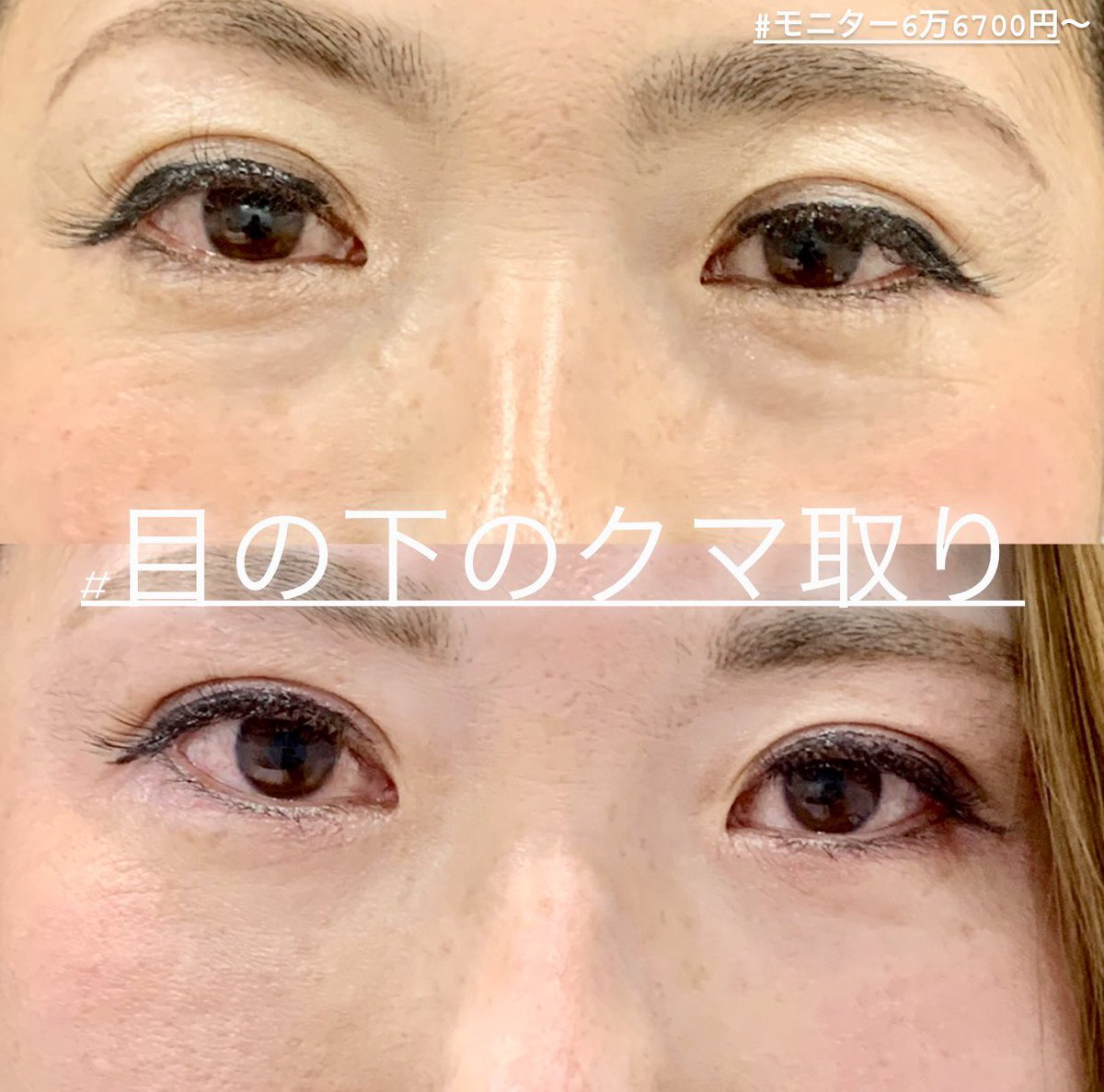 糸リフト 二重整形 鼻整形 ルラ美容クリニック院長 武内大 V Twitter 目の下のクマ ふくらみ取り 1ヶ月後 目の下のクマ ふくらみが 改善して若々しくなりましたね 目の下のクマ ふくらみが改善すると若返ります もちろん脂肪注入の併用なしです 脂肪注入