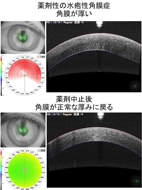 医師国家試験クイズくん Twitterren 水疱性角膜症では 角膜内皮細胞 再生しない が障害をうけて 水をくみ出せなくなり 角膜に多量の水がたまる病気です そのため 角膜に浮腫が起こり その厚さが著しく増してスリガラス状に濁り 非常に見えにくくなります 原因