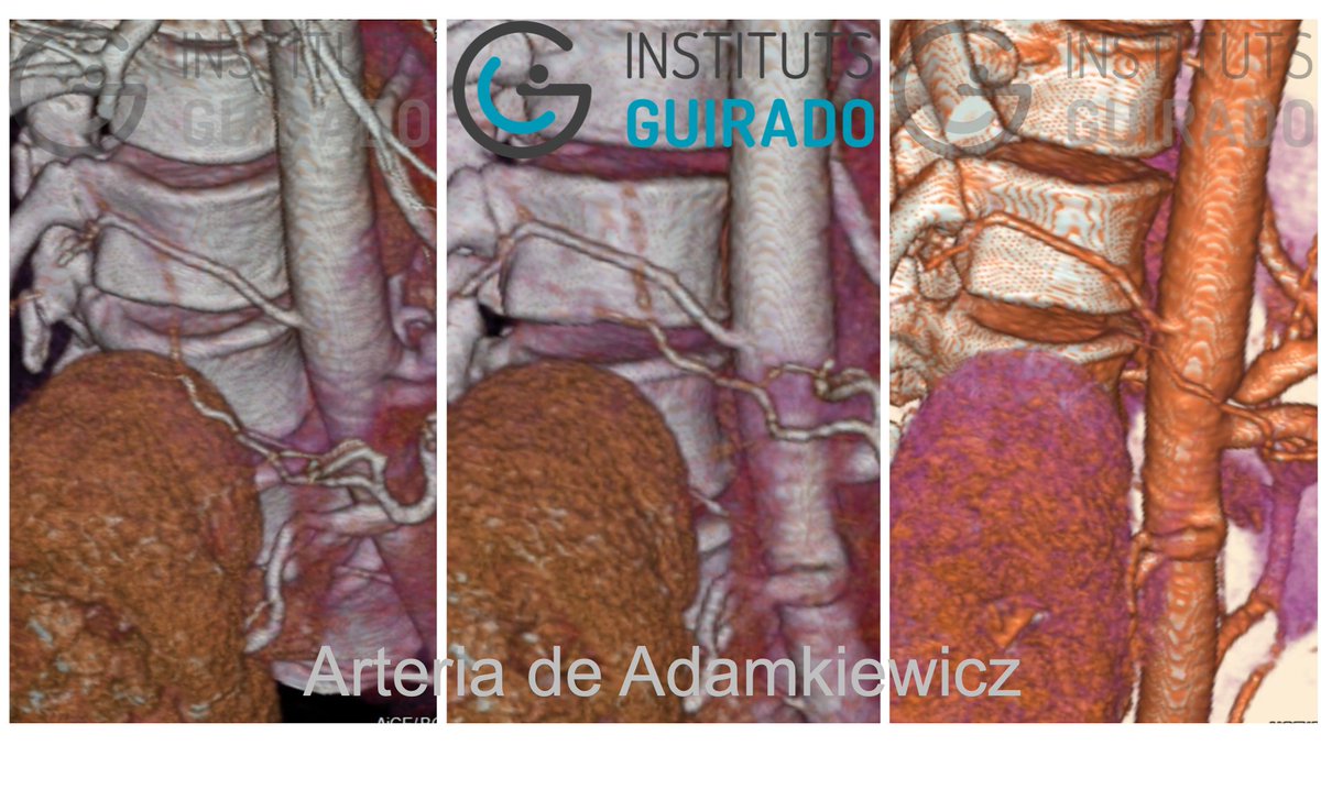 Arteria de Adamkiewicz. Estudio de angio-TC previo a intervención quirúrgica. #radiologia #tc #tac #diagnostico #angiotc #arteria #vascular #medicine #Diagnostic #3D #radiologists #tsid #radiographer