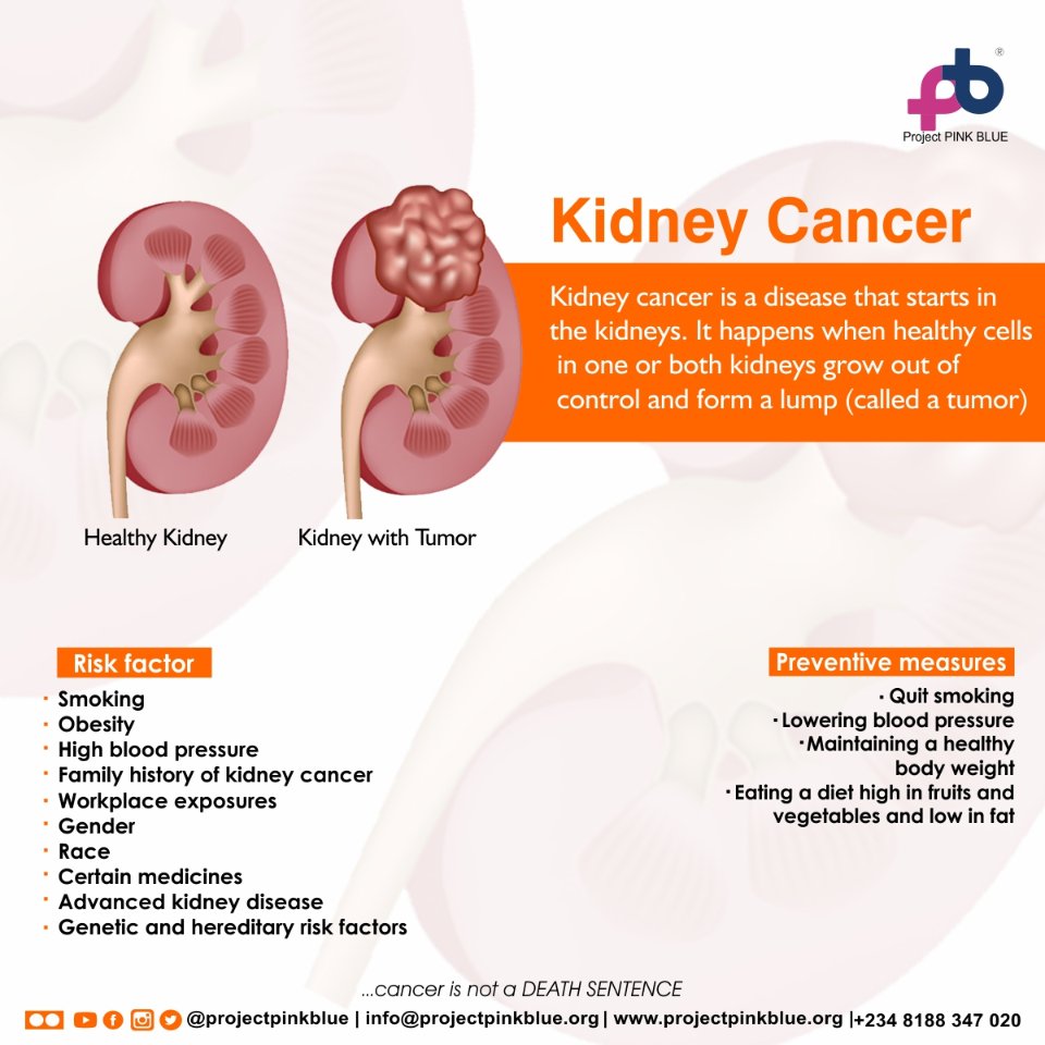 Kidney Cancer From Smoking