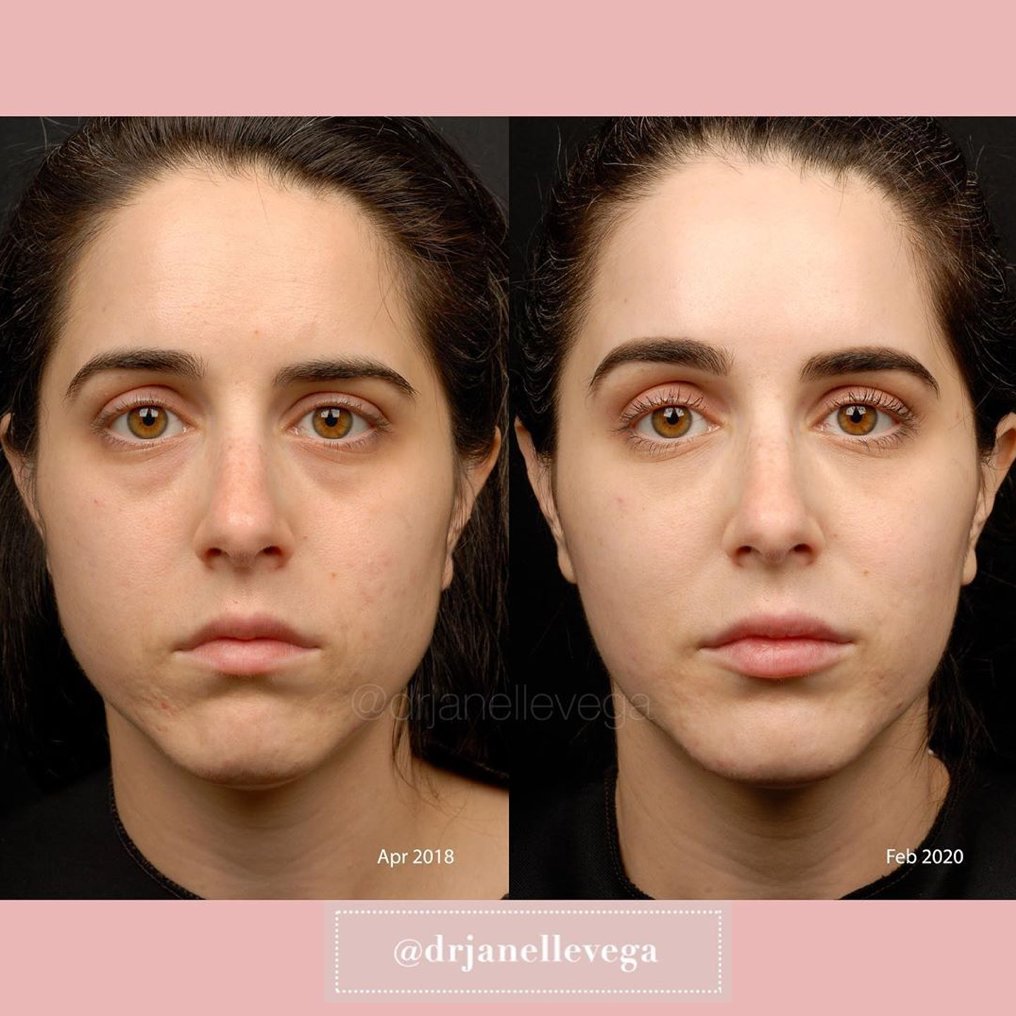 Be the after in everyone else's before pics! <a href="/drjanellevega/">Dr. Janelle Vega</a> shows how an individualized plan can help bring out your best features. Visit soo.nr/MQ2L for more info. #LoveYourSkin #MayoralDerm