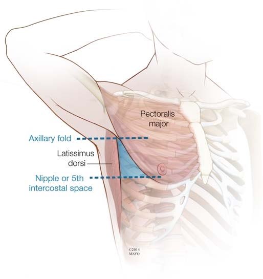 Triángulo de seguridad para insertar tubos de tórax 

Security triangle for chest drain insertion 

Tomado de: Hernandez, Et al. (2016). Tube Thoracostomy: Increased angle of insertion is associated with complications. The journal of trauma and acute care surgery. 81. 10.1097/TA