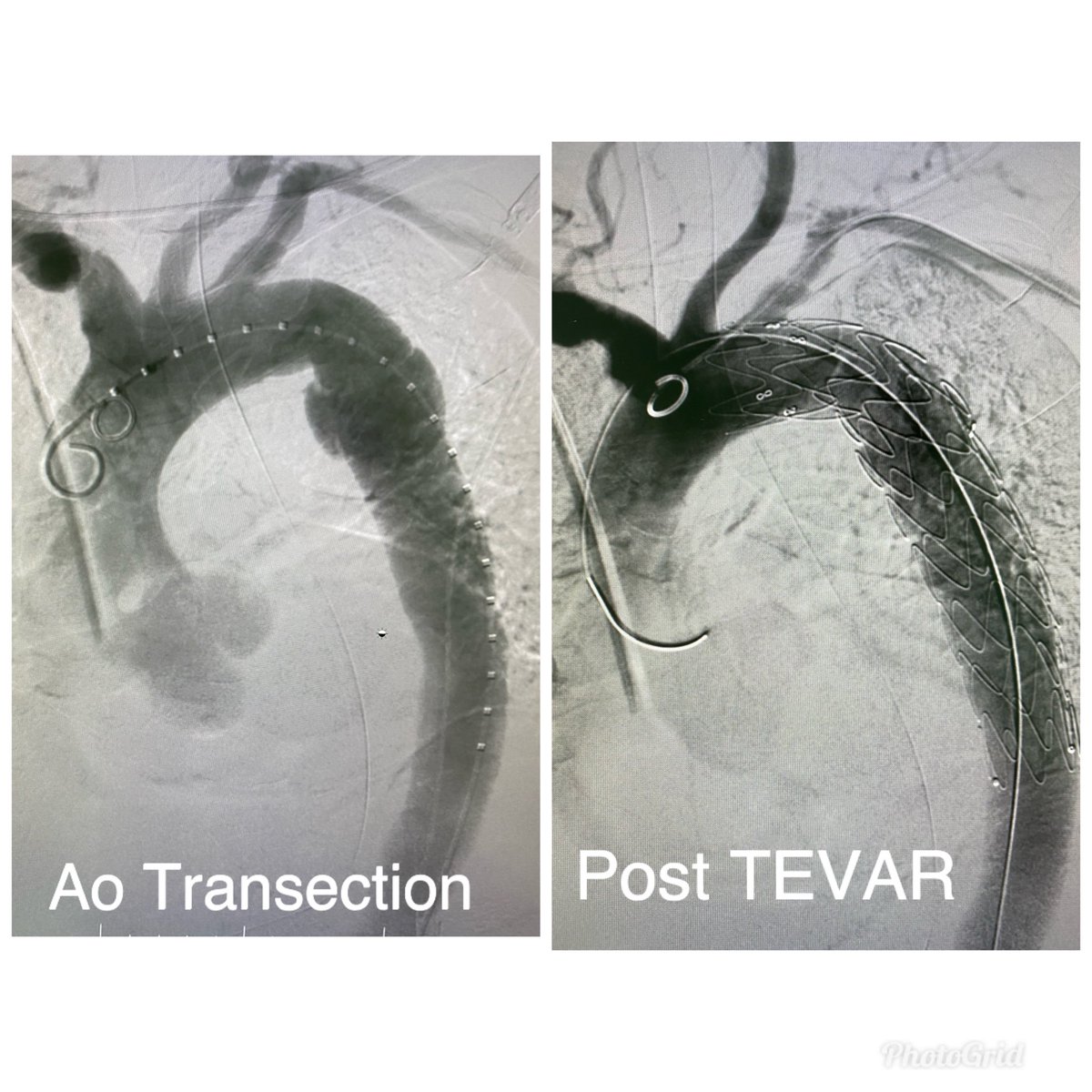 drmanishy's tweet photo. 56 yo involved in a high velocity #trauma aortic #transection managed by simple #TEVAR with @Medtronic valiant. Patient discharged to home by a week. https://t.co/4ZpJ5yqg6z