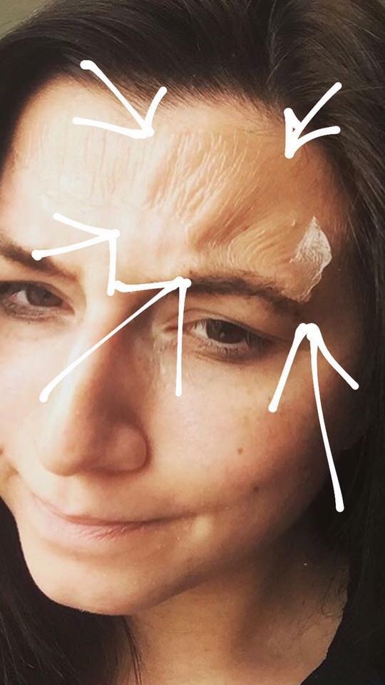 MedicaForte's tweet photo. #ThePerfectPeel will improve the overall tone and texture of your skin, lighten and brighten, remove or reduce sun damage and soften fine lines and wrinkles, improve acne skin conditions and Melasma AND slow down the ageing process, all with a treatment that takes just 15 mins! https://t.co/4pGf9yIF2x