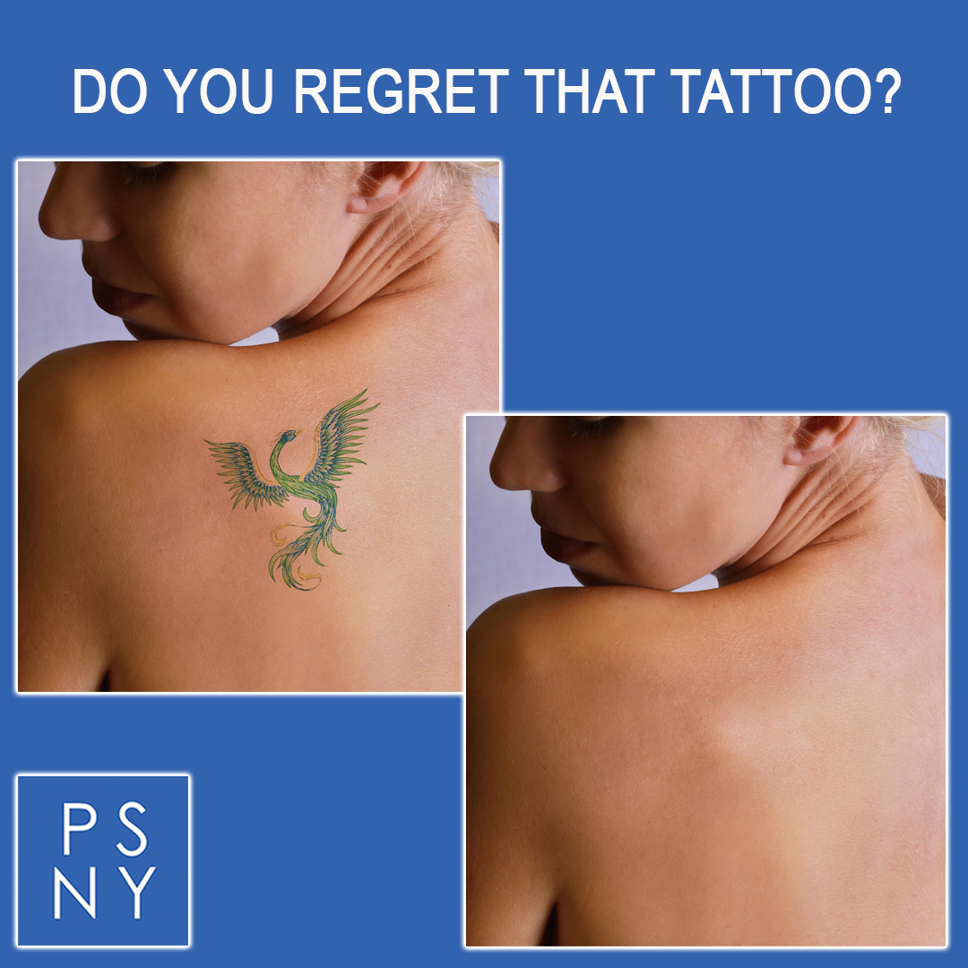 psofny's tweet image. Laser Tattoo Removal can help you eliminate that tatto you regret. Call us to schedule a complimentary consultation and learn more about this state of the art laser procedure 516-773-9200