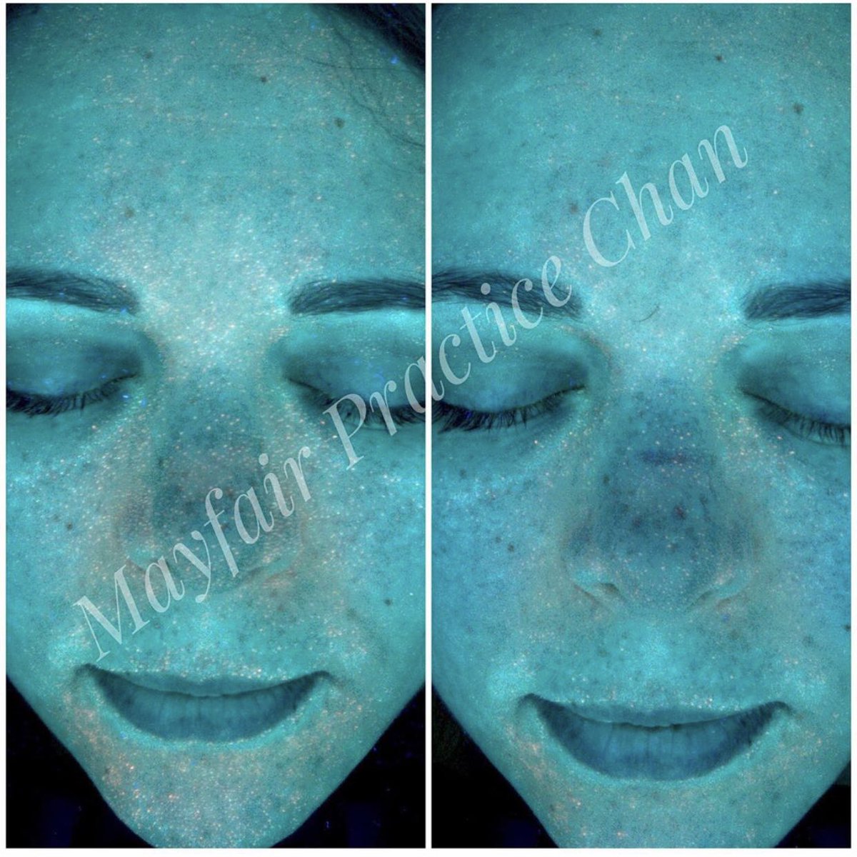 Wow! 🤩 IMMEDIATE HydraFacial results! These photos show an immediate improvement after a #HydraFacial treatment, where you can see the significant reduction in orange dots! mayfairpractice.co.uk