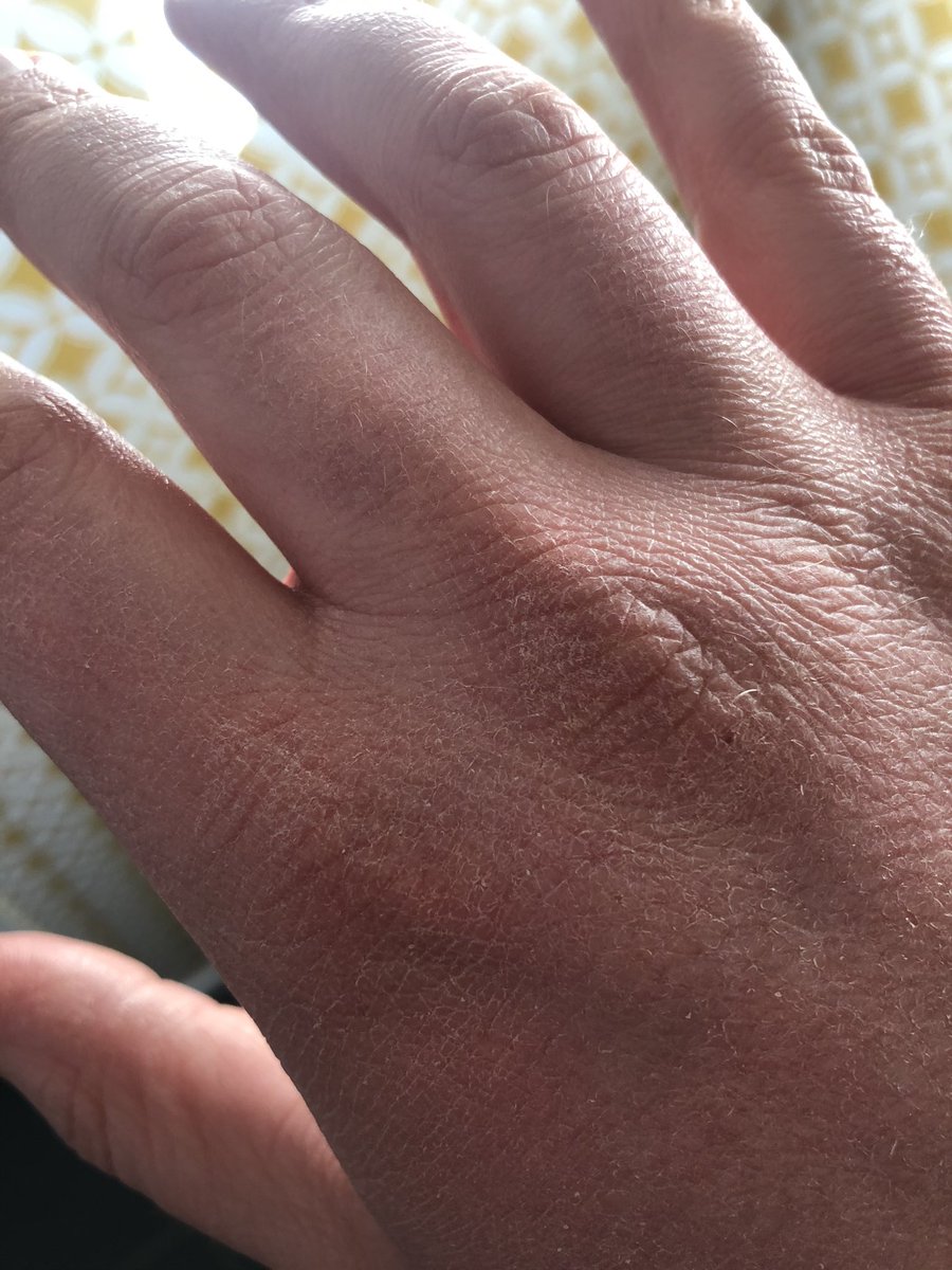 olamedvind's tweet image. Show me your #Coronahands ! Washing my hands this often makes them really really dry...