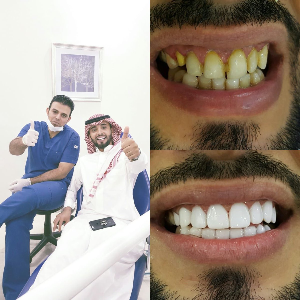 dubontclinic's tweet photo. اقوى عروض ابتسامة هوليوود لدى #عيادات_ديبونت 
.
.
عروض الابتسامة 16 سن مستمرة لاخر شهر مارس
.
سارع بالحجز والاستفسار:
☎️0112777745
☎️0112772213
📱0555959414
.
.
الشغف نحو الجمال💫💫
.
.
#ابتسامة_هوليود  #اليرموك #الرياض_الان #الطايف_الان #العاصفه_الترابيه https://t.co/NBS5rhUvkL