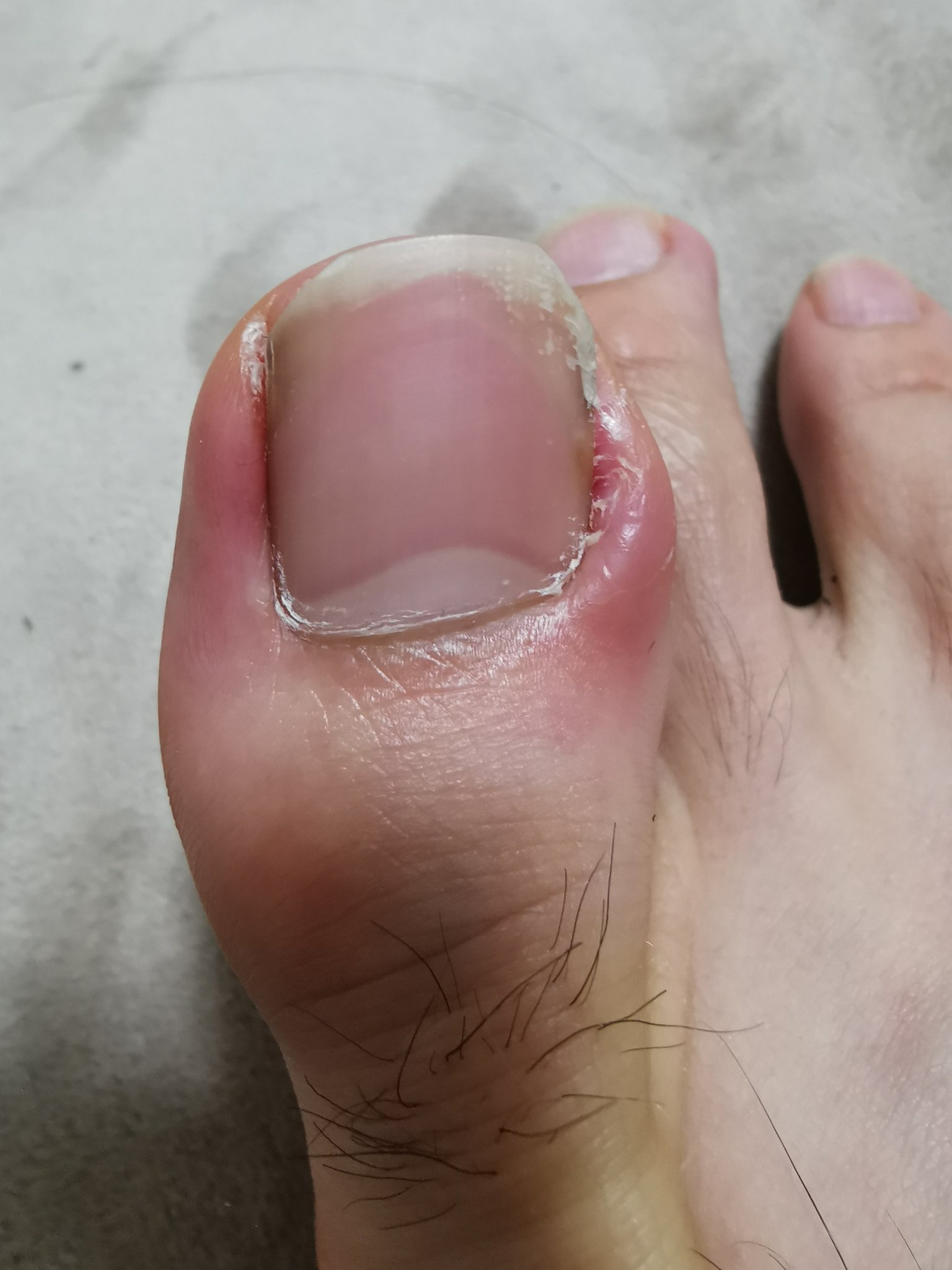 Takuma Harada V Twitter 足の指がひょうそになっちゃって痛 い でも病院行くの面倒だしなあ