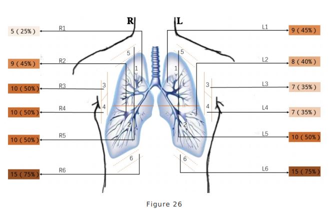 PratsEM's tweet image. For #POCUS findings in #COVID19, Peng article referenced often. The earlier article (*not peer reviewed!) has more thorough methods + lots of figures. We hope to have a podcast on this topic out soon #COVID19Foam bit.ly/33kWo1H