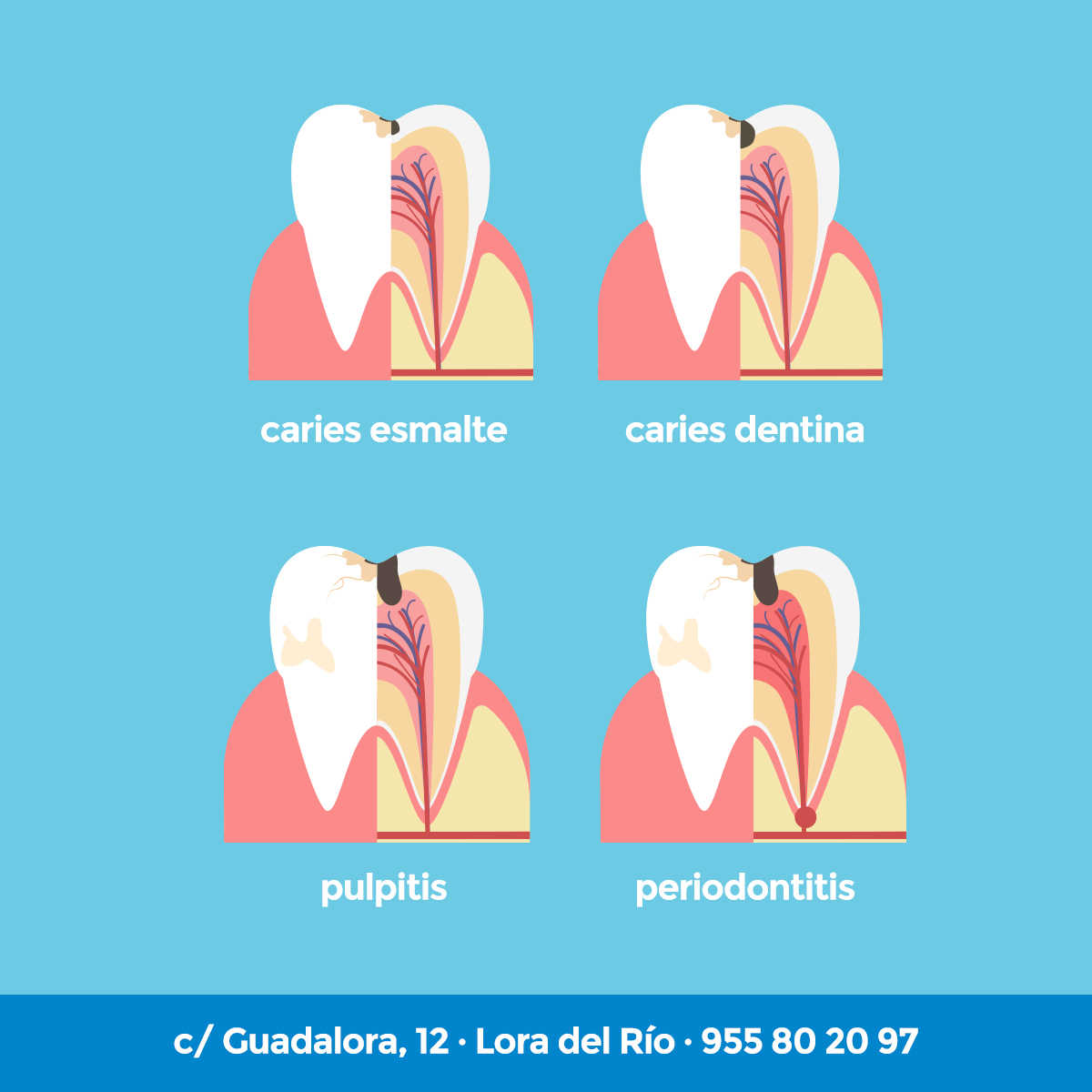 guadalora's tweet photo. ¡Lo que ocurre desde que se produce una caries en nuestro diente hasta que llega a una periodontitis. ¿No cres que es mejor aplicar un tratamiento dental en la 1r fase?
#caries #periodontitis #tratamientodental #odontologiaguadalora https://t.co/bSAZJ2Utxz