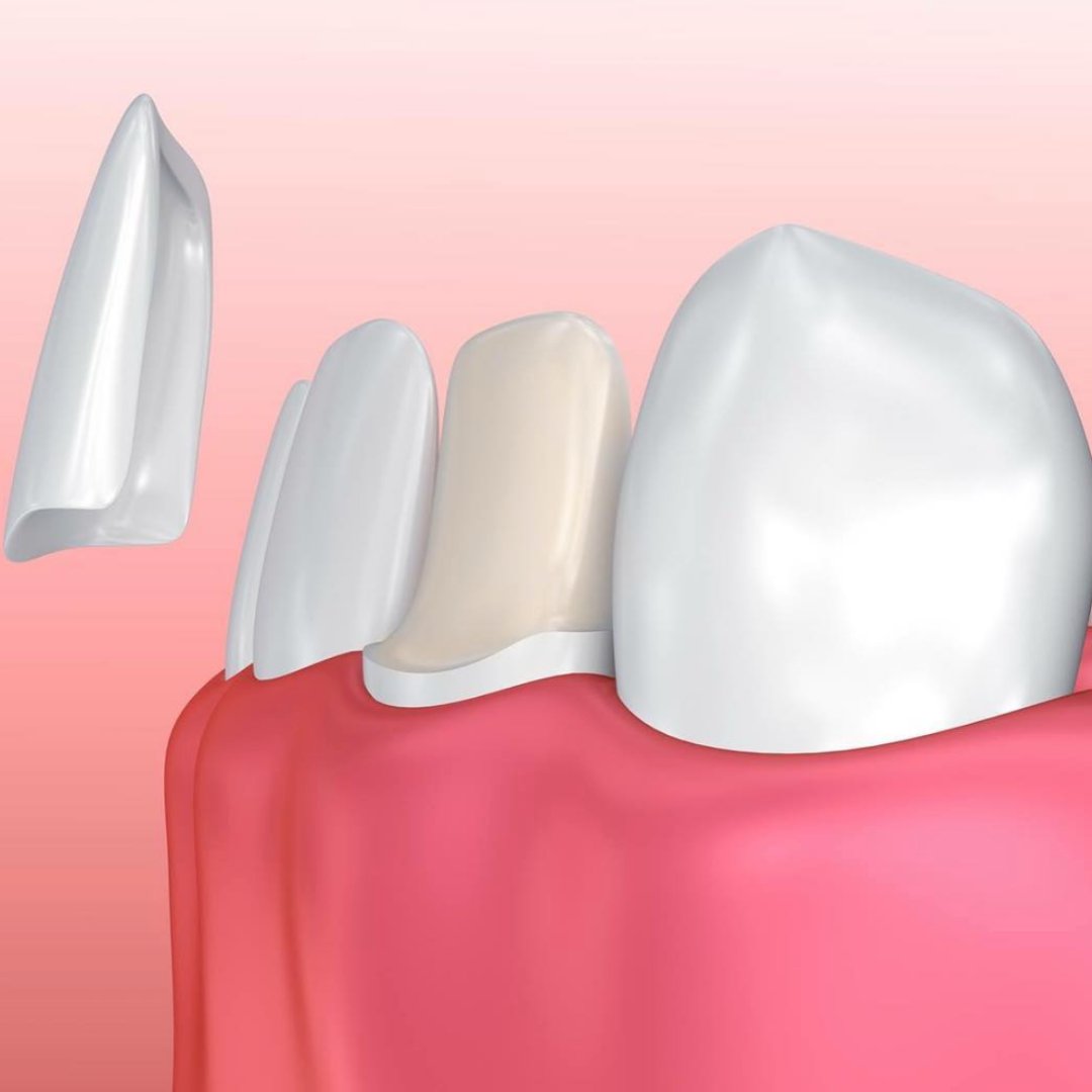 Are you feeling self-conscious about chipped or misshapen teeth? 
Porcelain veneers could be the answer to help you smile with confidence again! Visit our website to see our range of treatments today! 
#veneers #dentist #chichester #westsussex
ow.ly/rWkU50ygnuS