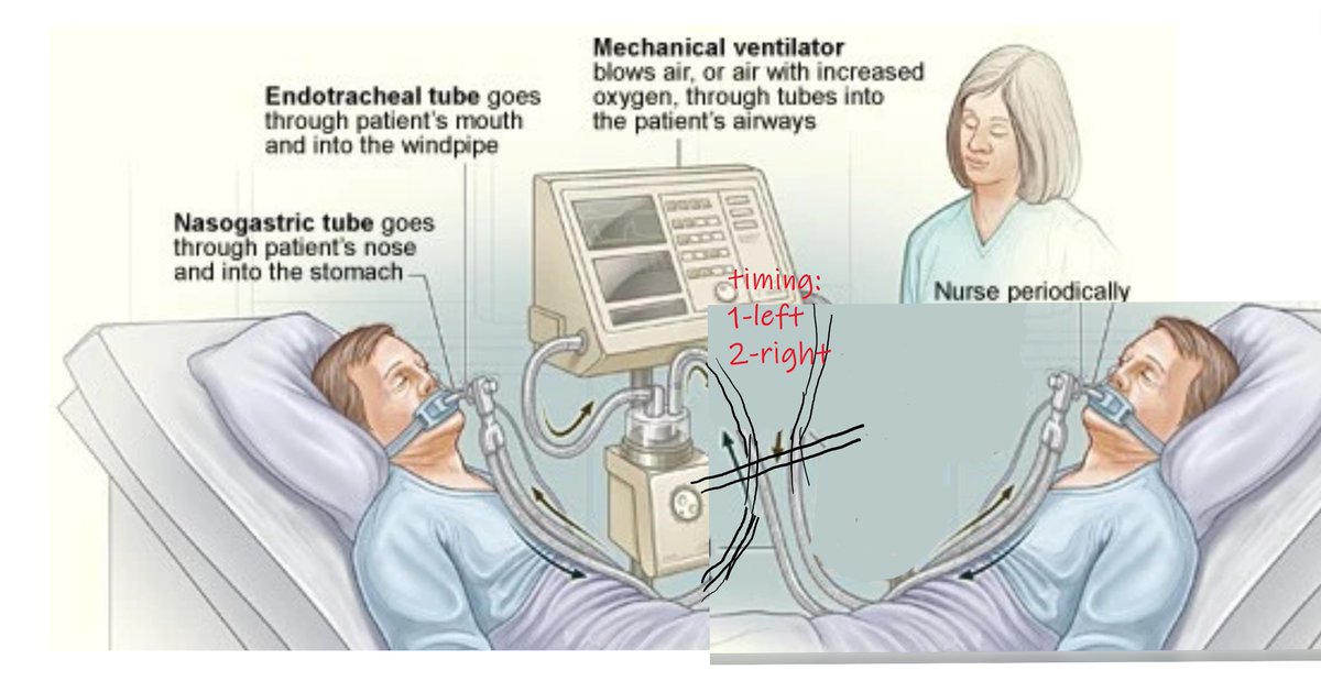 MFischetti's tweet photo. @brucefenton @jeremyphoward ... like in the picture below. I know this is just naive, but ... who knows? Maybe someone can elaborate this #HyperVentilator idea https://t.co/wMqJ3g4SSm