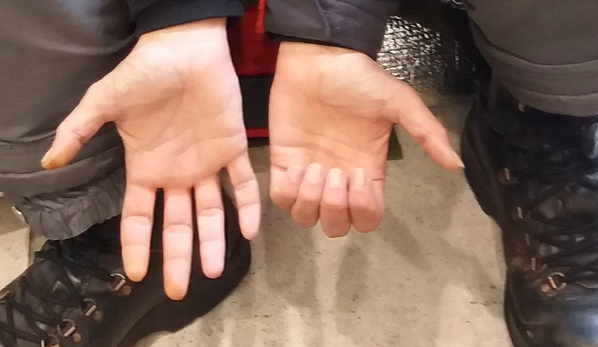 BillieHuman's tweet photo. #coronaUK #COVID19 #message to #Stockpilers Whole #UK from @DHSCgovuk to #RoughSleepers like me are #dispairing of you
#WashYourHands after using the #toliet and #BeforeEating
Use #tolietpaper sparing so EVERYONE can #washhands
Don't #Stockpile
If I can do it...... https://t.co/nAPfBujZBQ