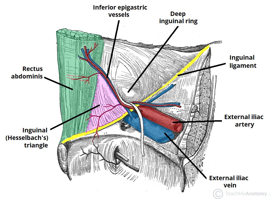 ABSITEQofWeek's tweet photo. #absitequestionoftheweek Poupart's ligament derives from the aponeurosis of the external oblique. The Ilioinguinal nerve travels with, but external to, the spermatic cord. Hesselbach's triangle is bordered by the inguinal ligament, rectus abdominis, and inferior epigastrics. https://t.co/99x8z9lgxp