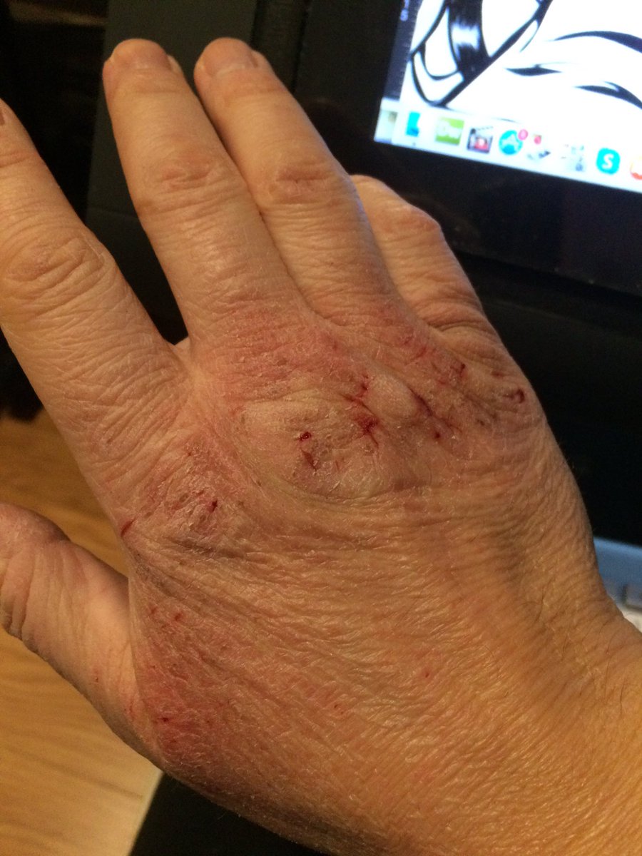 batmankm's tweet photo. This hand washing shit is getting out of control!!! I am becoming a straight up Zombie!!!! Ahhhhh! #DeadHands #TheWalkingArtist https://t.co/CWwhJ7VUdf