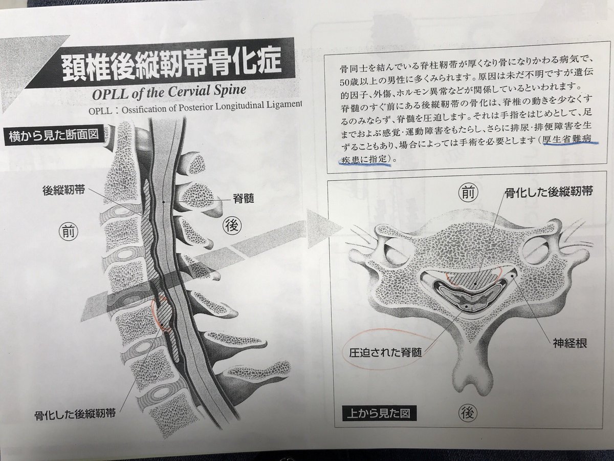 頸椎後縦靭帯骨化症 頸椎後縦靭帯骨化症