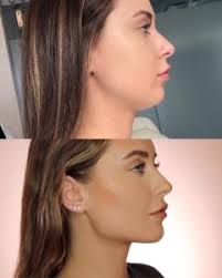 Cosmetics_2021's tweet image. Have you heard about genioplasty? - A cosmetic procedure used to reshape or reposition the chin to enhance facial harmony
Discuss more like the same at: cosmetics.alliedacademies.com
#cosmeticsconference #cosmetologyconference