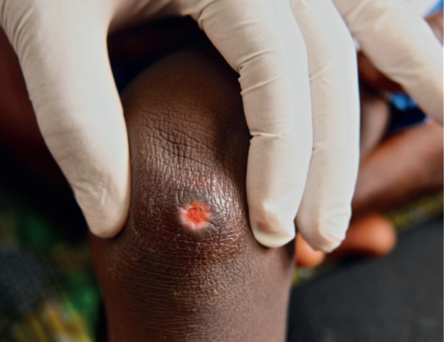 anthonywsolomon's tweet image. 📢Early #Buruli ulcers (&amp;lt;10cm diameter, like this one📸in 🇬🇭by @dralexkumar) can be cured with oral💊rifampicin + clarithromycin. 

Thanks to a great RCT in 🇧🇯&amp;amp;🇬🇭, published @TheLancet: bit.ly/39UcySt there’s now no need for daily streptomycin💉

#IDtwitter #beatNTDs